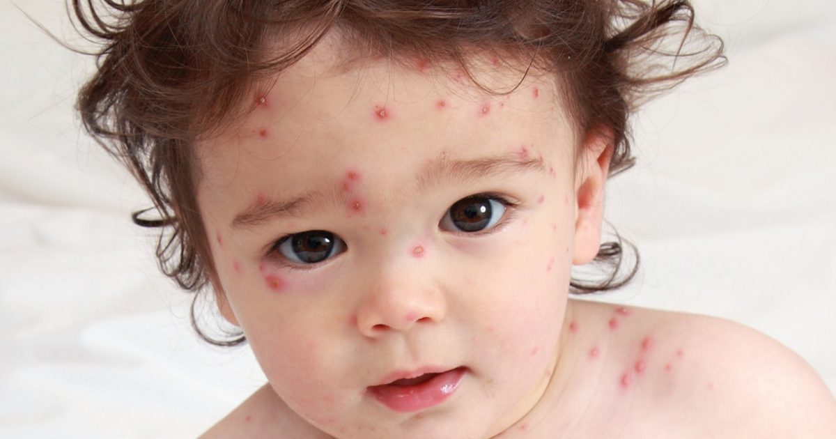 pic Chicken Pox Pictures Baby 5 tips to soothe your child when they